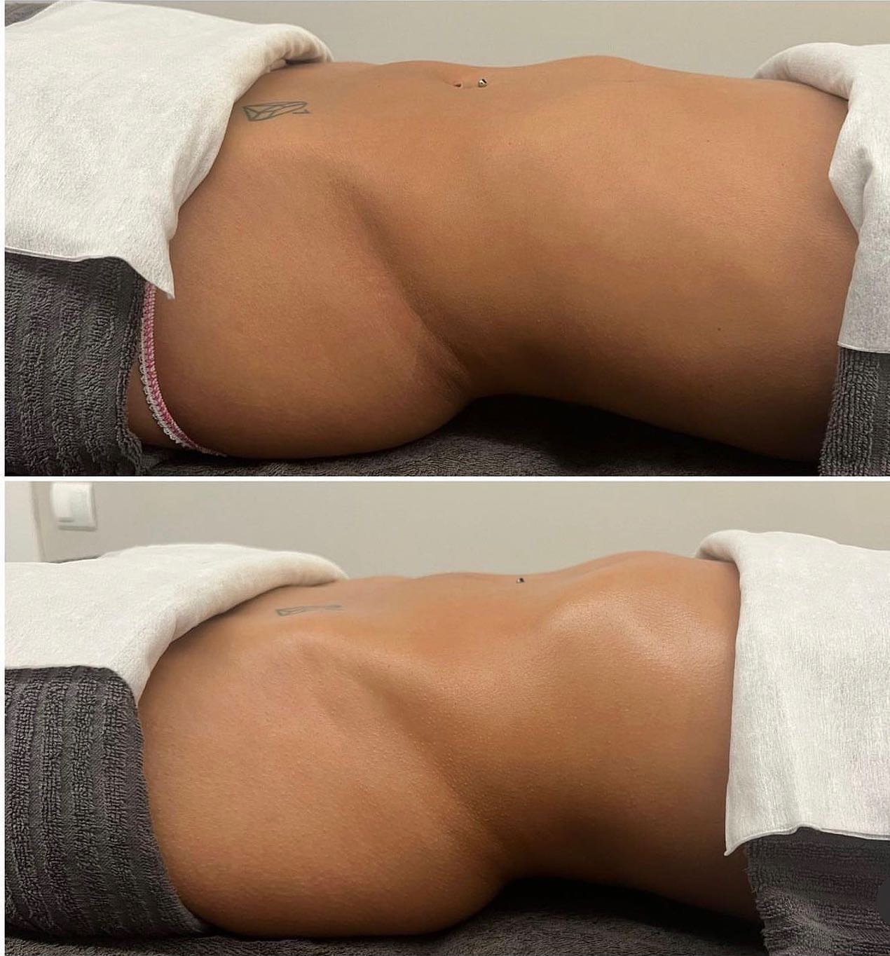 Addome di profilo prima e dopo il massaggio
