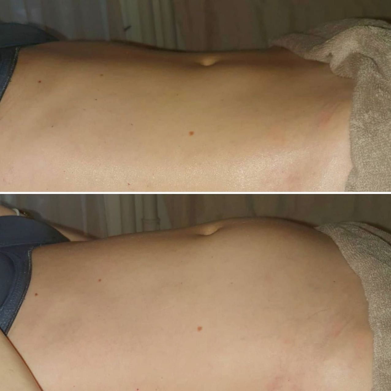Addome di profilo prima e dopo il massaggio